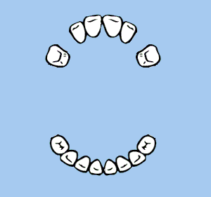 Oben fehlen noch die Eckz&auml;hne.